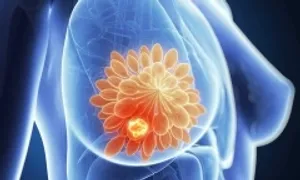 Phát hiện đột phá về cơ chế ngăn ung thư vú di căn Phát hiện đột phá về cơ chế ngăn ung thư vú di căn
